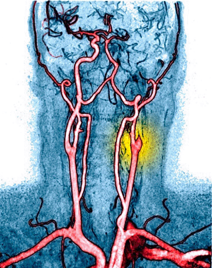 Image: Colored MRA of a coronal view through the neck of a 38-year-old patient, showing a blocked right internal carotid artery, which has led to a bleed in the brain (Photo courtesy of Simon Fraser / Newcastle Hospitals NHS Trust). Image: Colored MRA of a coronal view through the neck of a 38-year-old patient, showing a blocked right internal carotid artery, which has led to a bleed in the brain (Photo courtesy of Simon Fraser / Newcastle Hospitals NHS Trust).